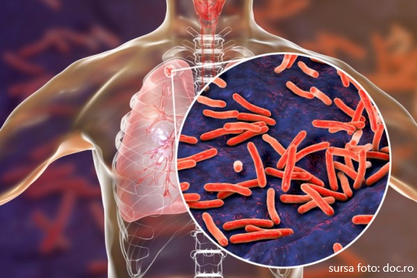 Controale gratuite pentru depistarea tuberculozei în mai multe localități din județul Sălaj